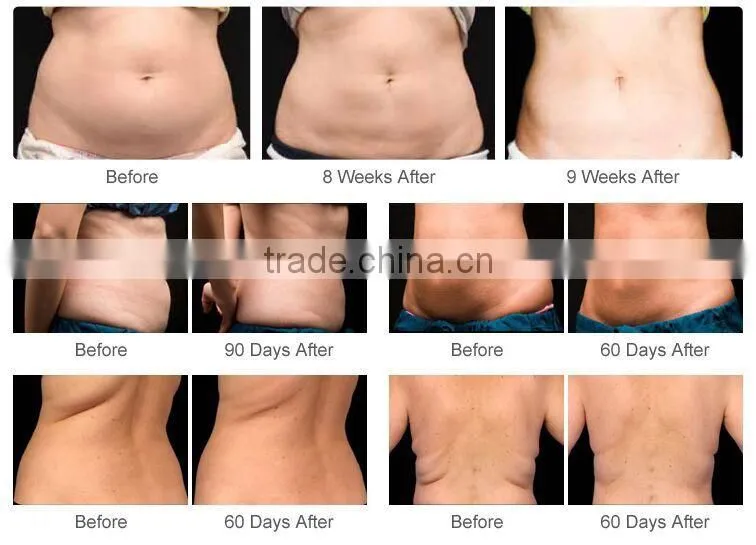 New design in 2016 fast slimming equipment cryolipolysis machine lose weight from china