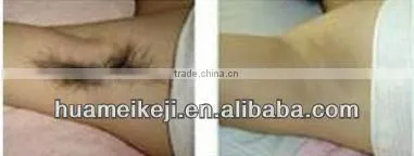 laser Hair removal in laser beauty equipment Medical CE approval