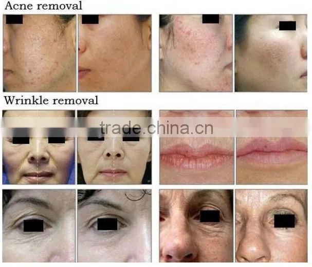 40w Metal USA RF Tube Medical Laser Co2 Fractional Laser Vaginal Tightening