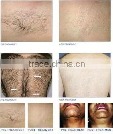 permanent hair removal / laser face hair removal machine
