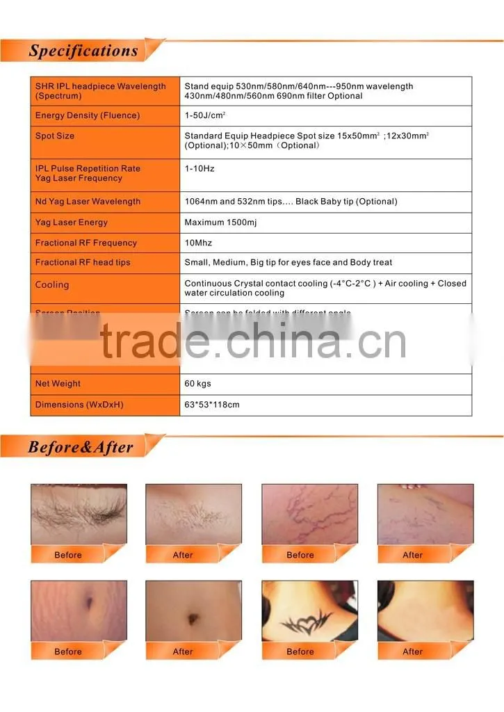 Painless IPL laser hair removal nd yag laser tatoo removal & ipl elight machine