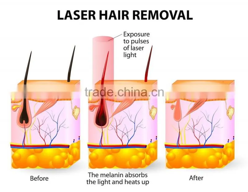 2015 New Arrival 808nm Diode Laser hair removal equipment DL-A1