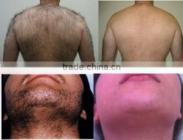 High power professional ipl photo rejuvenation machine