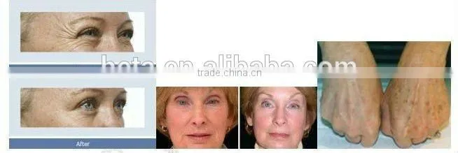 Guangzhou HETA Best rf skin tightening Anti-wrinkle face lifting machine