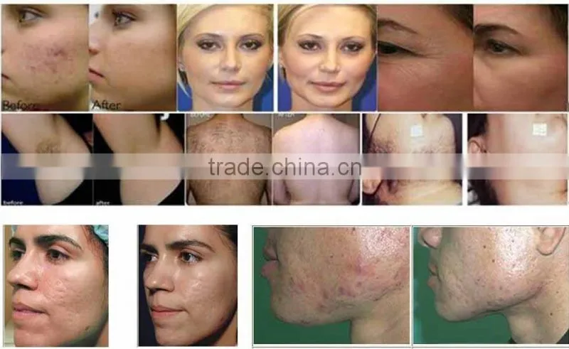 2016 Chinese ipl shr hair removal machine from Beijing multifuncion for big promotion