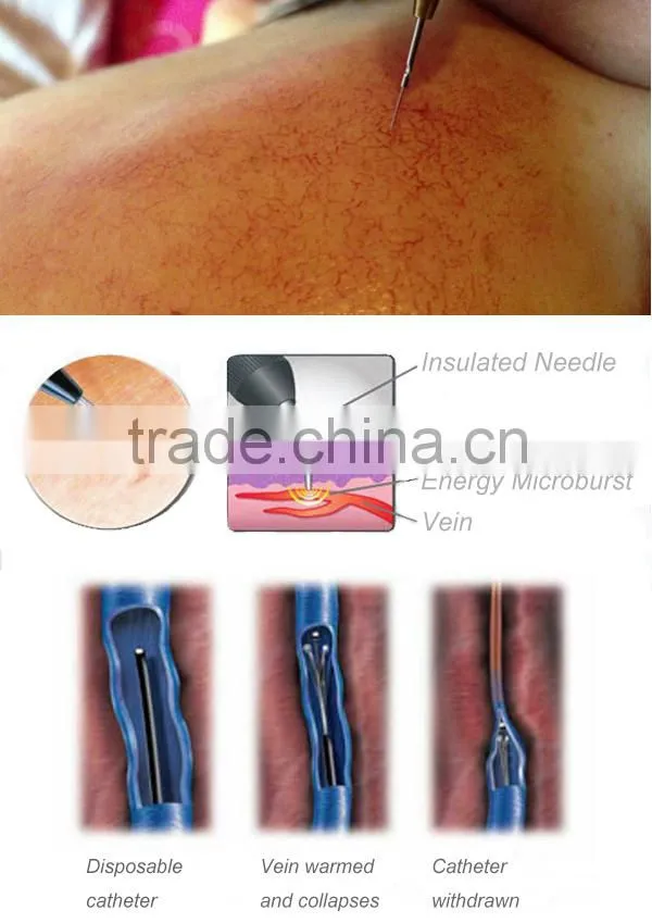 Vein removal high frequency vascular veins removal redness removal