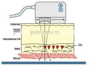 Ultrasound transducer type high intensity ultrasound