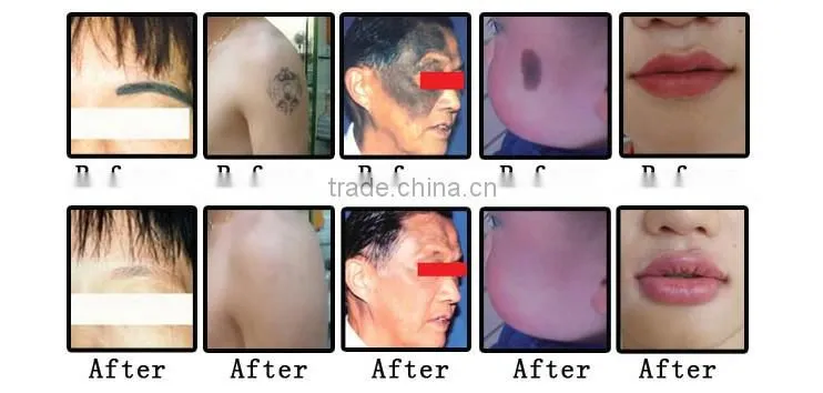 ipl+rf shr nd yag laser hair removal skin care multi-functional machine