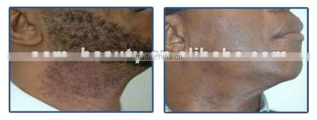 No Pain Laser Hair Removal Machine Laser Diode--A011