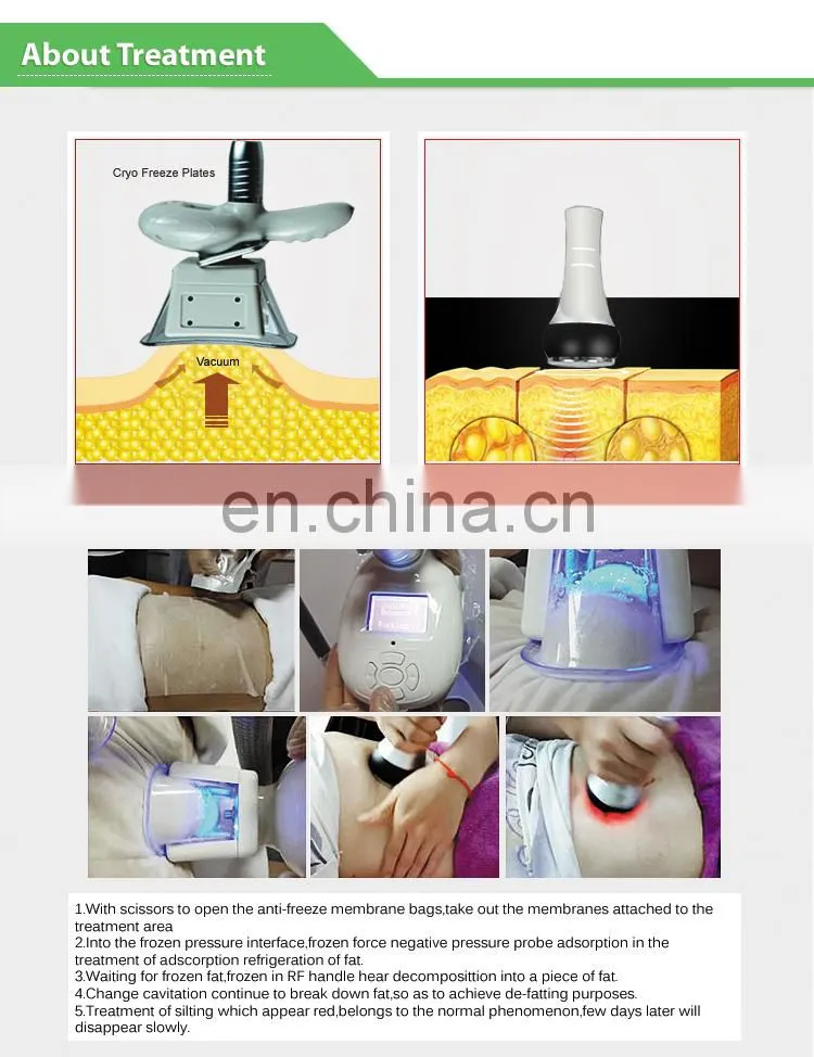 cryolipolise with 4 handles fat freezing cryotherapy machine