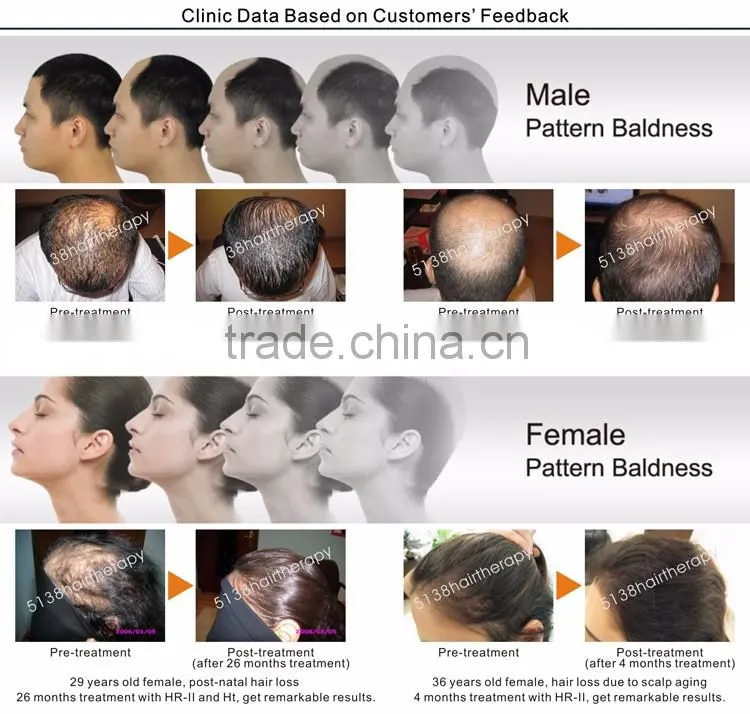 Professional/Newest PDT/EMS/Oxygen Jet Hair Rejunvenation System For Hair Regrowth and Anti-Hair Loss HR-II