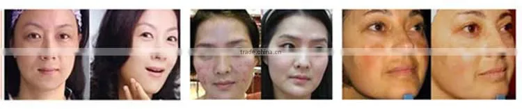 7 color PDT led blue light therapy acne light therapy face mask