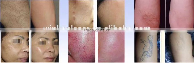 spa shr ipl hair removal