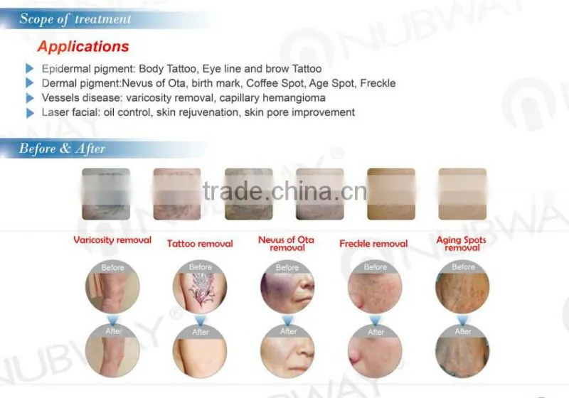 Hot sale q-switch nd yag laser machine for tattoo removal / q-switch nd:yag laser / nd yag laser impulse long impulse