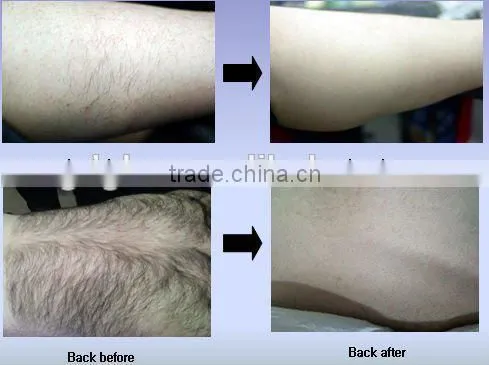 2015 Professional Pain-free 808nm diode laser hair removal machine for sale
