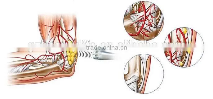 Non-invasive fat removal shockwave / acoustic wave / Technology