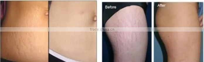 Best RF CO2 fractional laser skin treatment machine for chloasmas and pigmentation removal OY-11