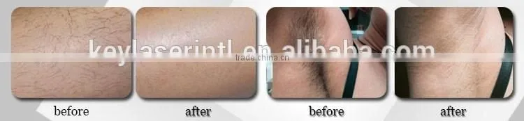 latest beauty equipmentipl shr laser hair removal machines shr ipl hair removal for sale with two handles