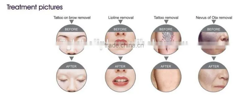 Manufacture elight ipl rf nd yag laser with great price