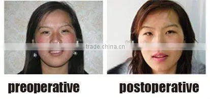 Removal Scar CO2 fractional laser beauty equipment