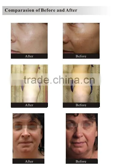 Face skin tightening machine for home use no needle mesotherapy machine