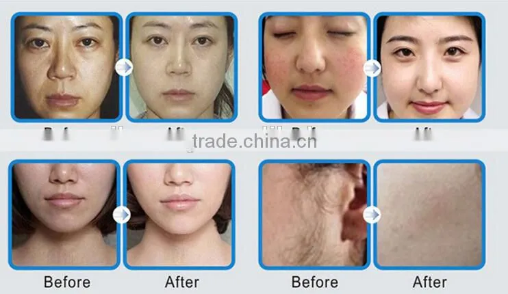 Portable IPL SHR&E-light hair removal equipment&machine
