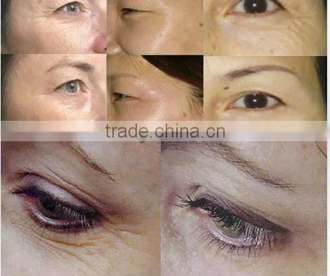Elight IPL RF Acne Treatment--C005