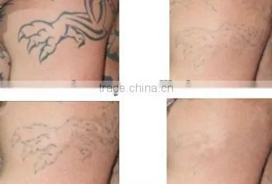 New Year Surprising Gift Laser machine with Q-switch yag for tattoo and eyebrow removal