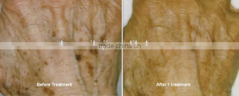 Chinese IPL hair removal from HUAMEI HM-IPL-B1