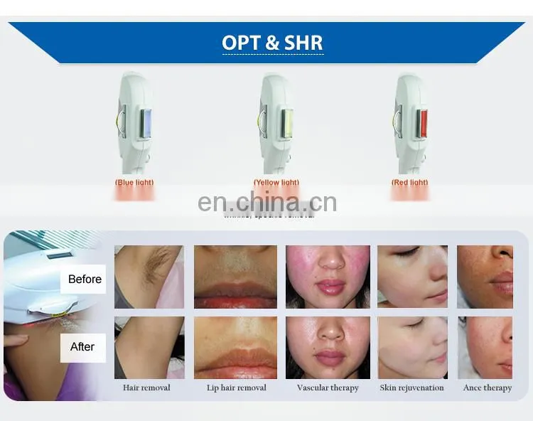 OPT ND YAG LASER RF Beauty Machine Elight Multi-functional Tattoo Removal Hair Removal