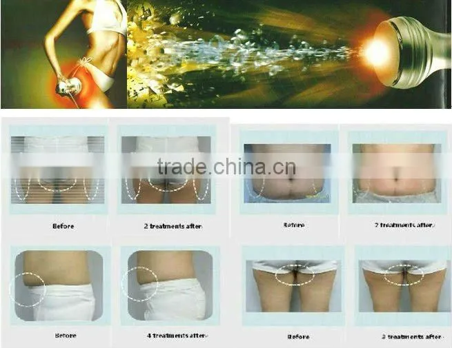 Best selling products 5 IN 1 ultrasonic cavitation device