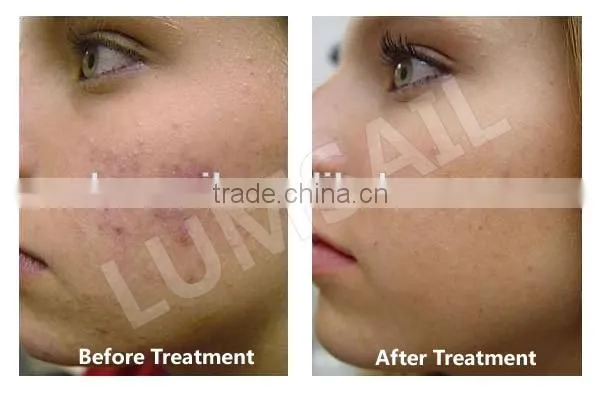 2014 New Arrival photo dynamic therapy pdt