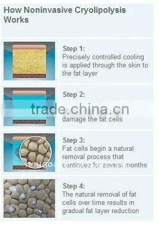Vacuum Cavitation RF Crylipolysis Equipment o-F1