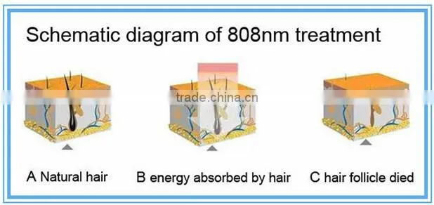 latest technology diode laser hair removal machine