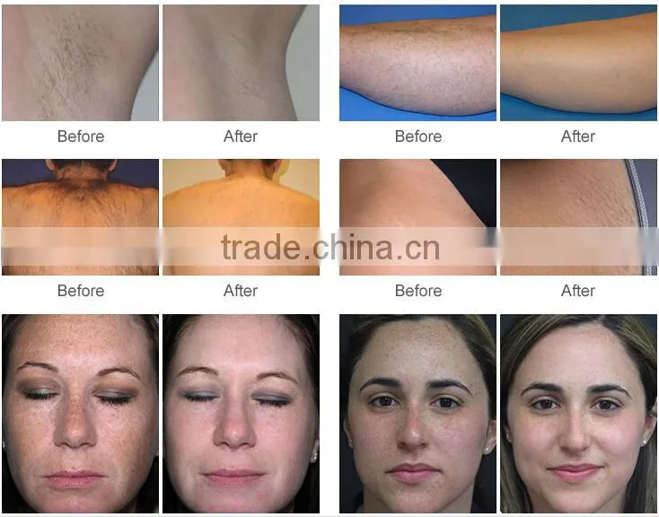 3 in 1 nd yag laser tattoo removal IPL RF hair removal machine