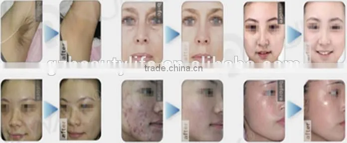 Vertical SHR IPL Elight hair removal equipment