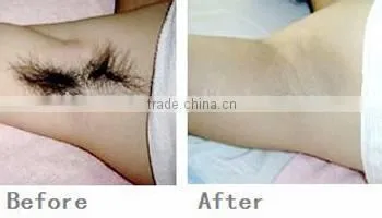 alex yag combo laser alexandrite hair removal 755nm q switched nd yag laser