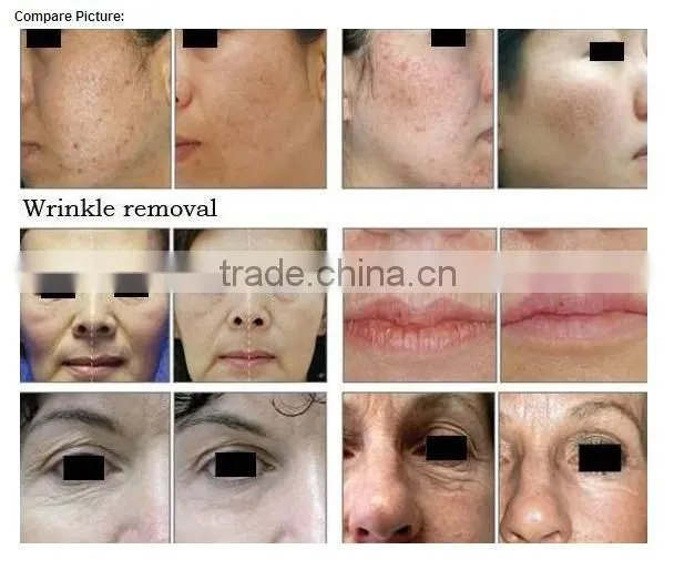 Patent design CE intense 10600nm RF CO2 fractional laser with 8.4 inch colorful touch screen for skin rejuvenation