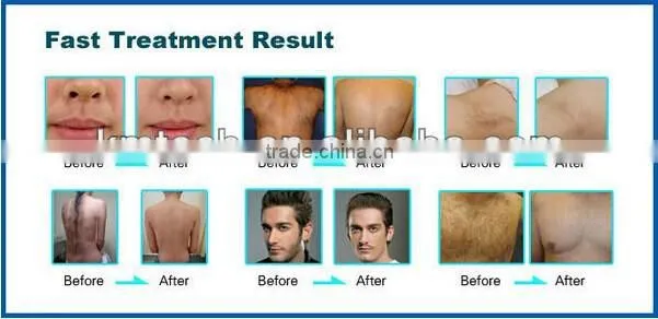 WOW!! SHR Skin Tightening & Permanent Hair Removal Equipment hig quality