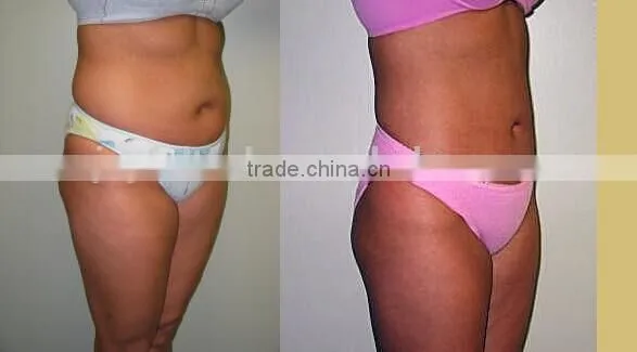 venze freeze machine for fat removal
