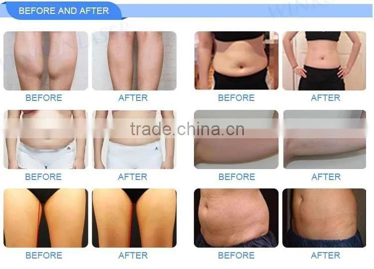 Cryolipolysis Beauty Salon Equipment / Fat Freezing Beauty Salon Equipment / Lipo Cryo