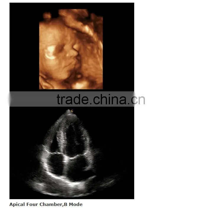 2016 new Portable Color Doppler(Optional 4D) for cardiac use
