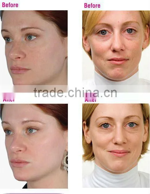 painless Derma roller/ 200 needles derma roller with replacable head for skin cure