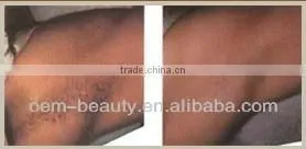 Good depilacion laser nd yag laser spider vein removal machine in hot sale