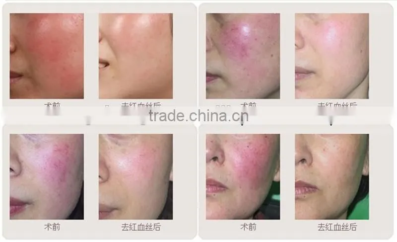 8.4 Inch Touch Screen Diode 980 laser Vascular care spider vein removal and varicose removal BD-980