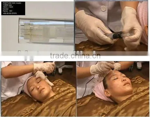 popular micro needle system/anti ageing/anti wrinkle/micro needle skin roller,derma rolling system