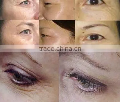 skin rejuvenation eye massage wrinkle removor skin lifting