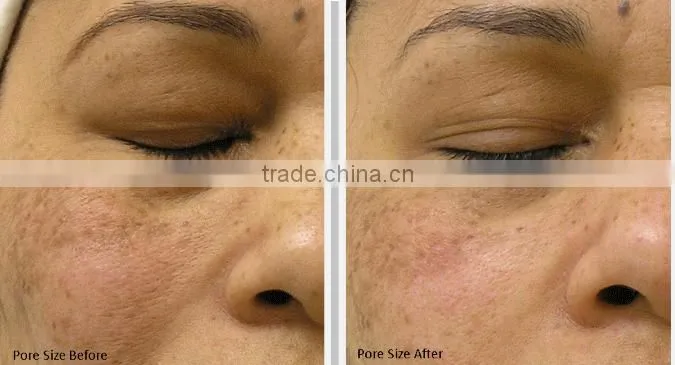 latest technology permanently remove hair machine delight facial hair remover laser facial rejuvenation