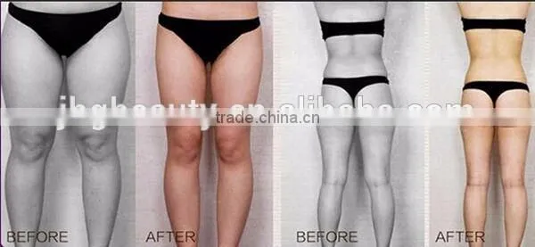 2016 Newest Model Body Shape Liposonix HIFU Slimming Machine for Anti Wrinkle Removal