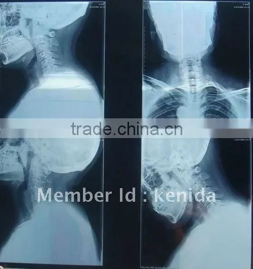 Medical film from manufacturer,x ray film,dry imaging film printed with fuji and agfa printers